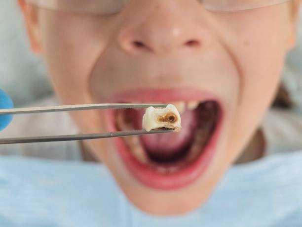 Best Emergency Treatment for Dental Infections or Abscesses in Sardis City, AL